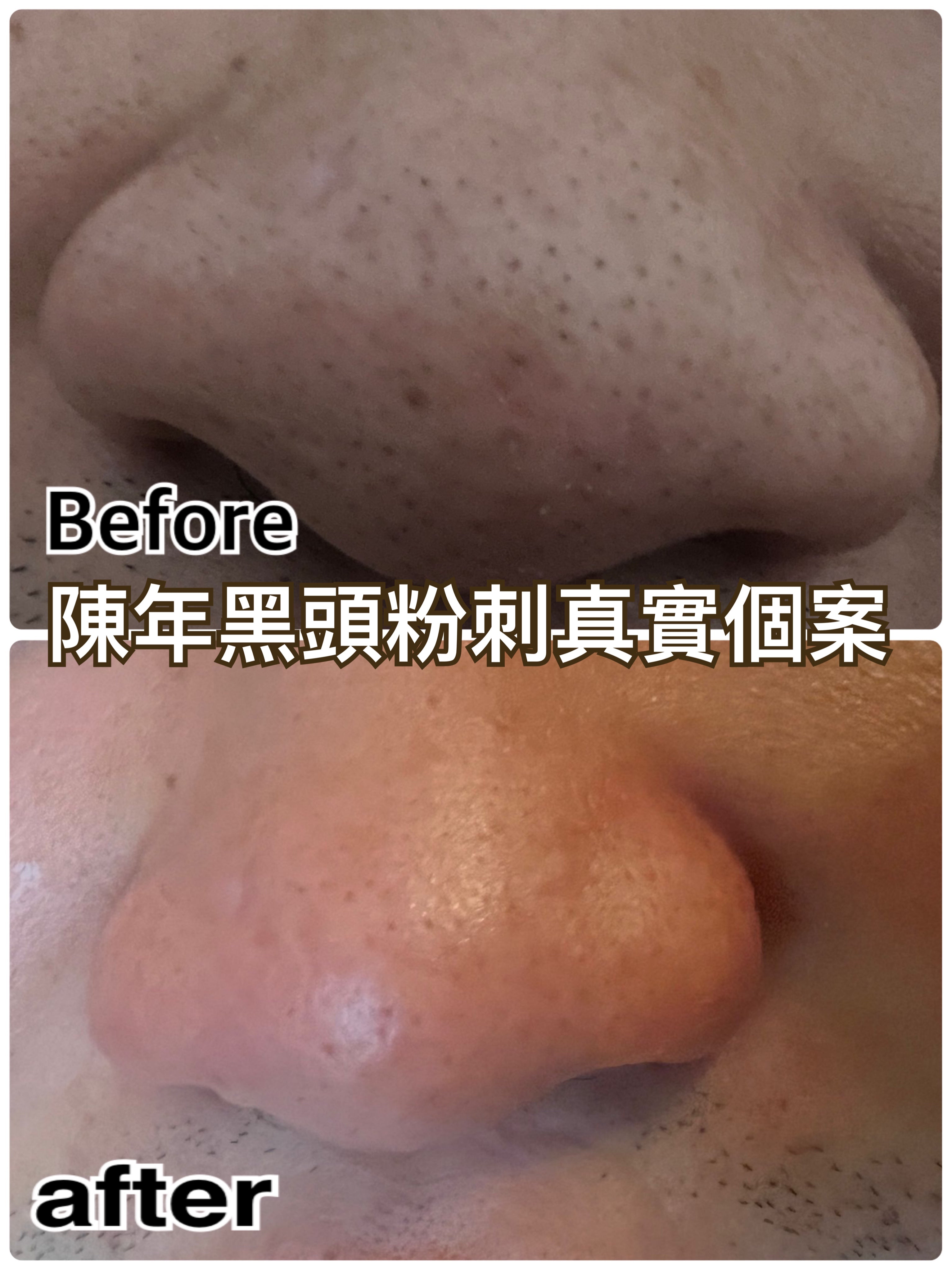法國神奇迅速黑頭水 Nose Pore Cleanser