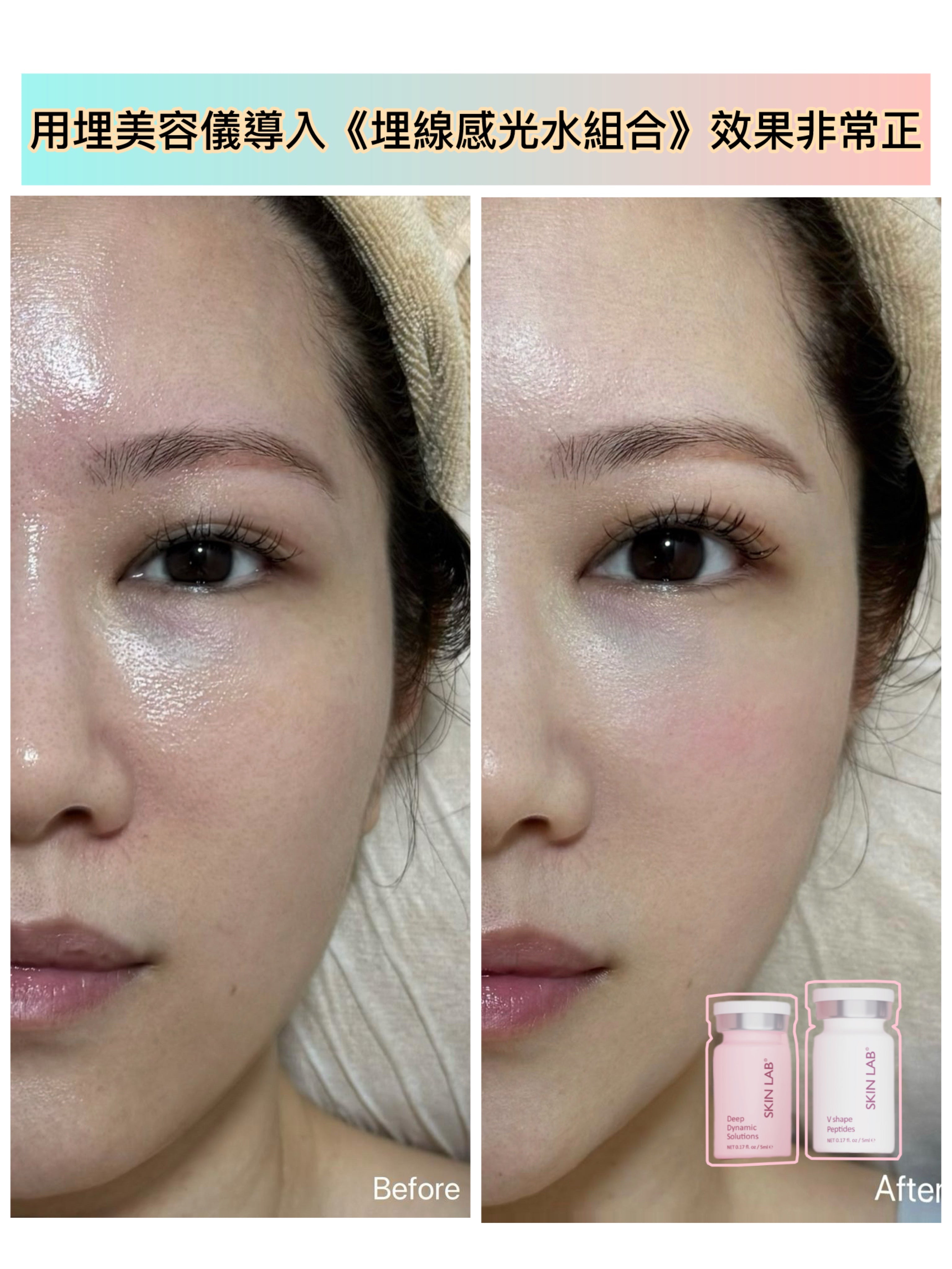 埋線膠原精華 V Shape Peptides